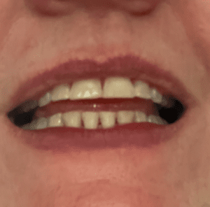 Melissa W Invisalign After Photo