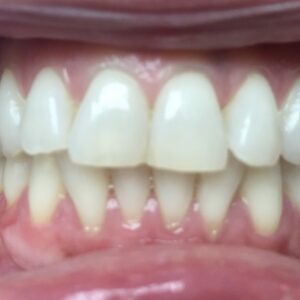 Sumeet S Invisalign After Photo
