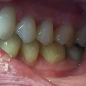 Sumeet S Invisalign After Photo