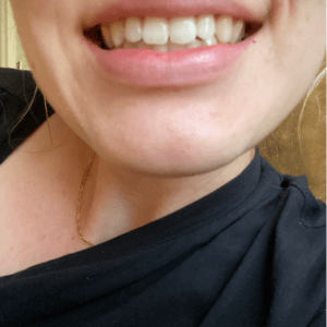 Sylwia J Invisalign After Photo