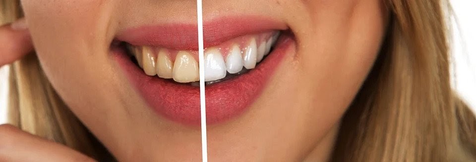 How Are Teeth Prepared For Veneers