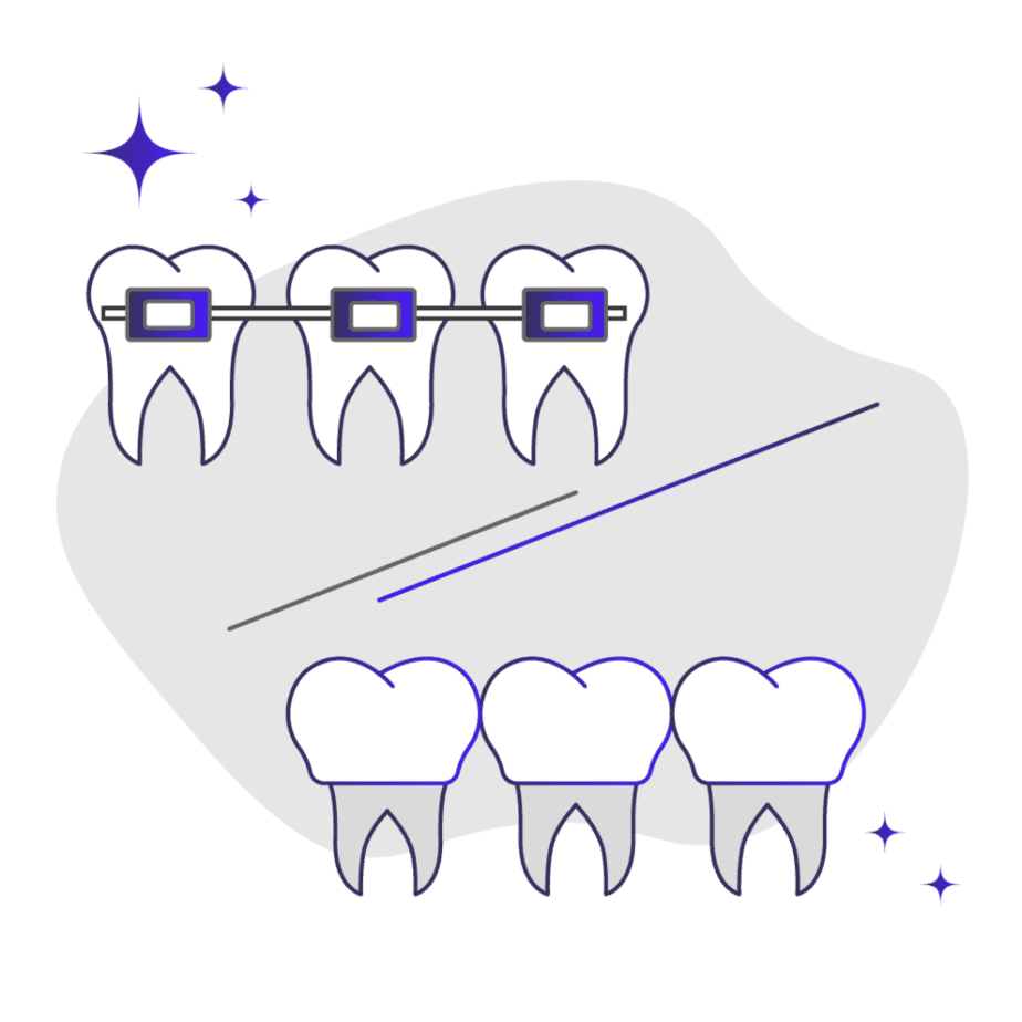 Braces vs veneers which is better