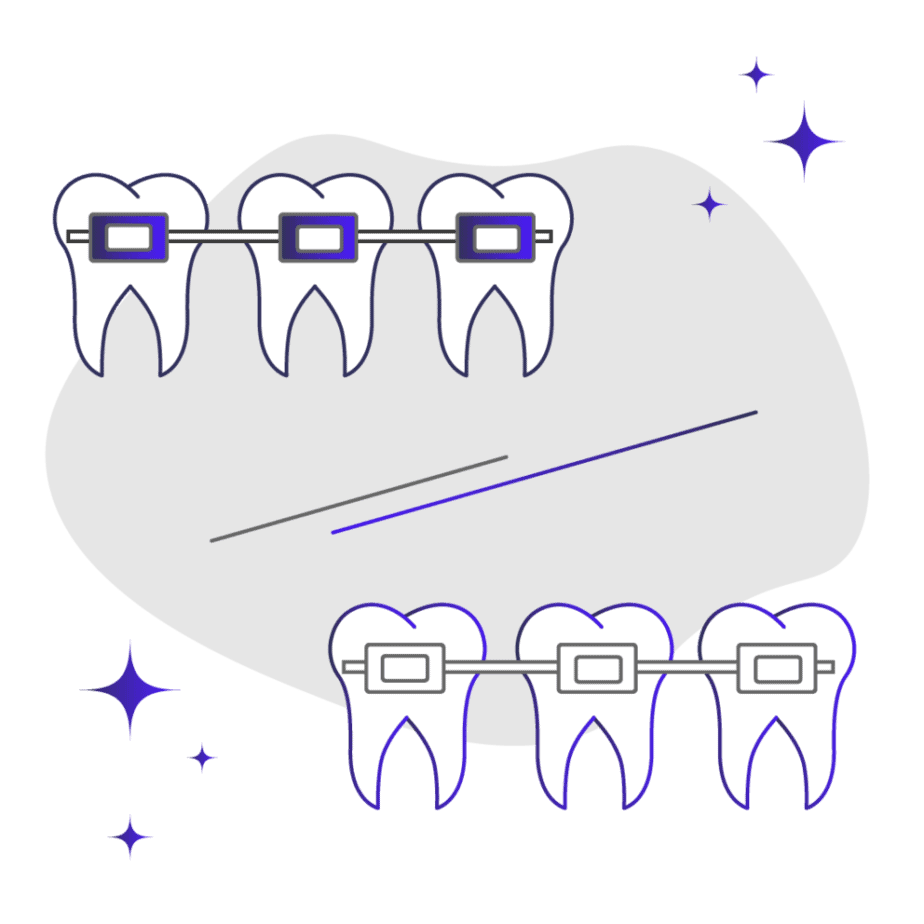 Metal vs ceramic braces comparison