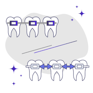 Traditional vs. Self-Ligating Braces: What’s the Difference?