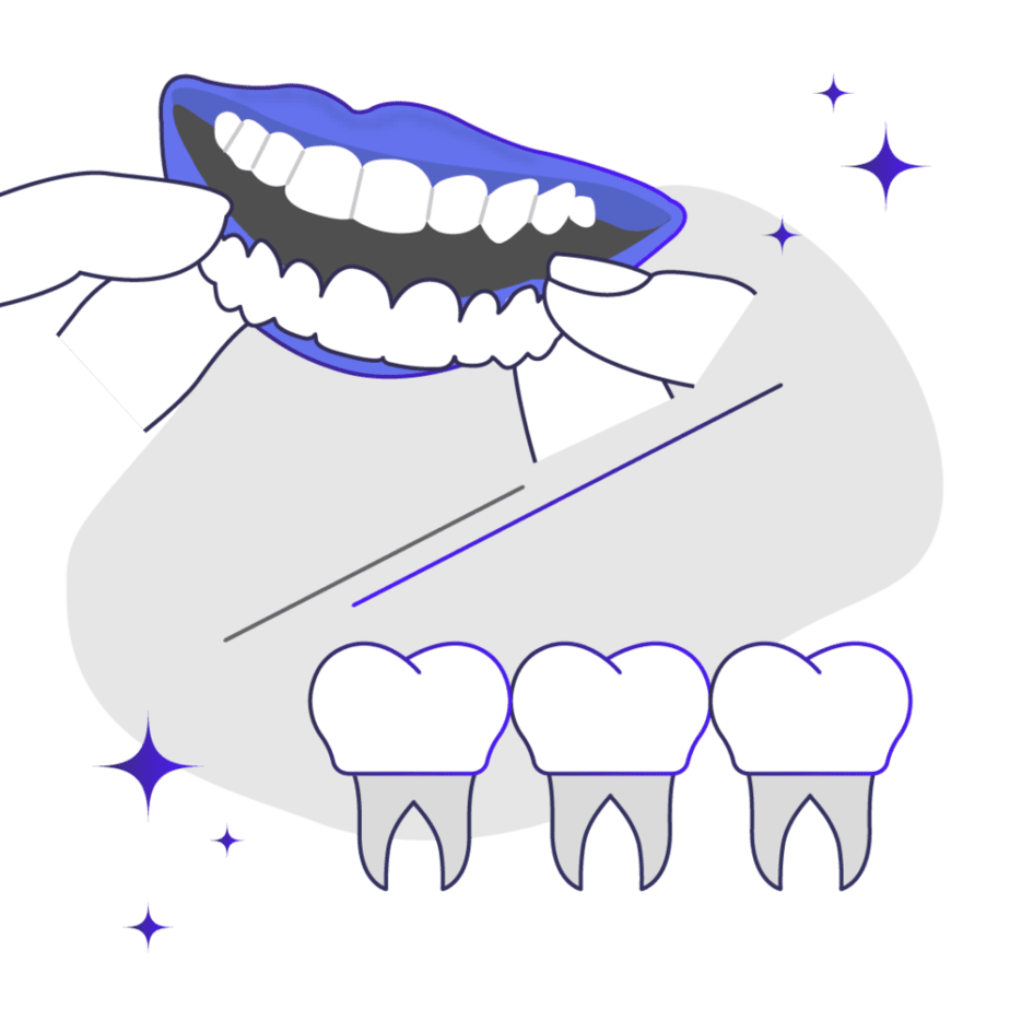 Snap-on veneers versus permanent veneers