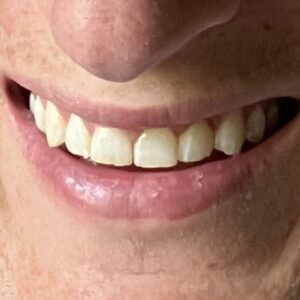 Natural smile without snap-on veneers