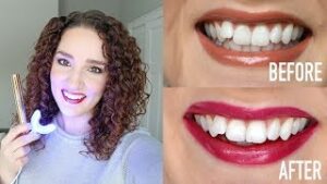 SNOW Teeth Whitening Review 4