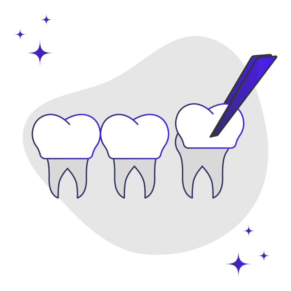 Composite Veneers