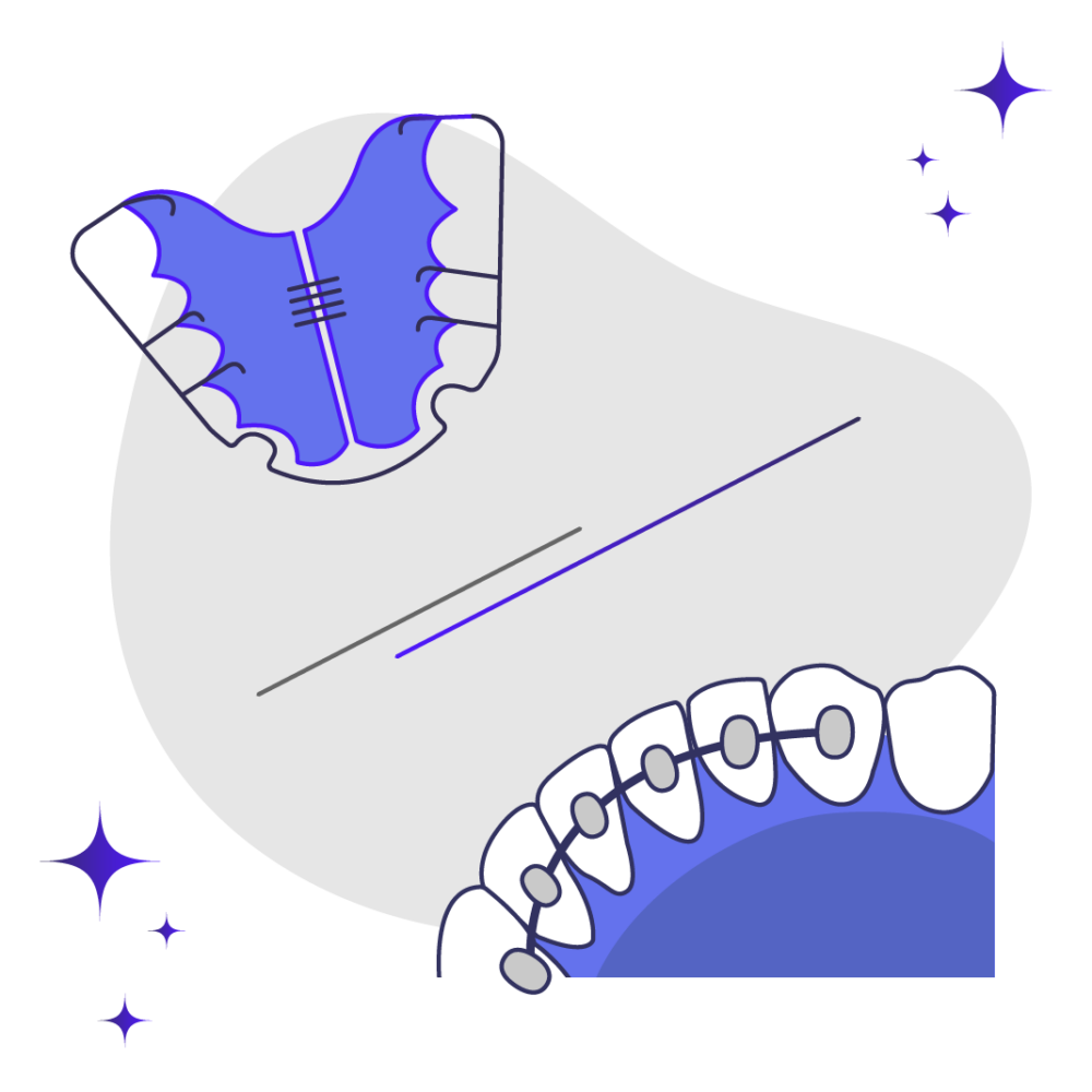 Permanent Retainers vs Removable Retainers