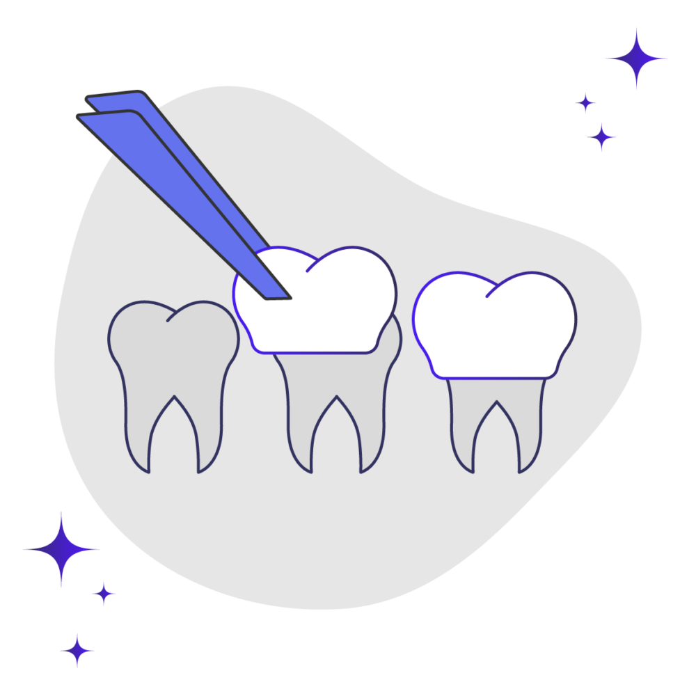 Porcelain Veneers