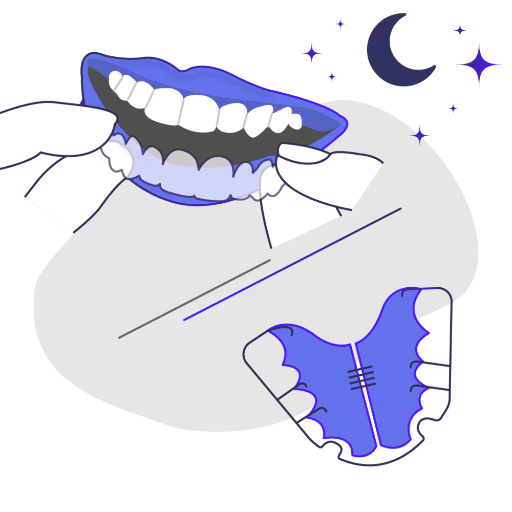 Retainer v Night Guard