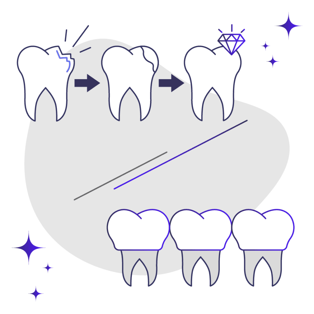 Dental Bonding v Veneers