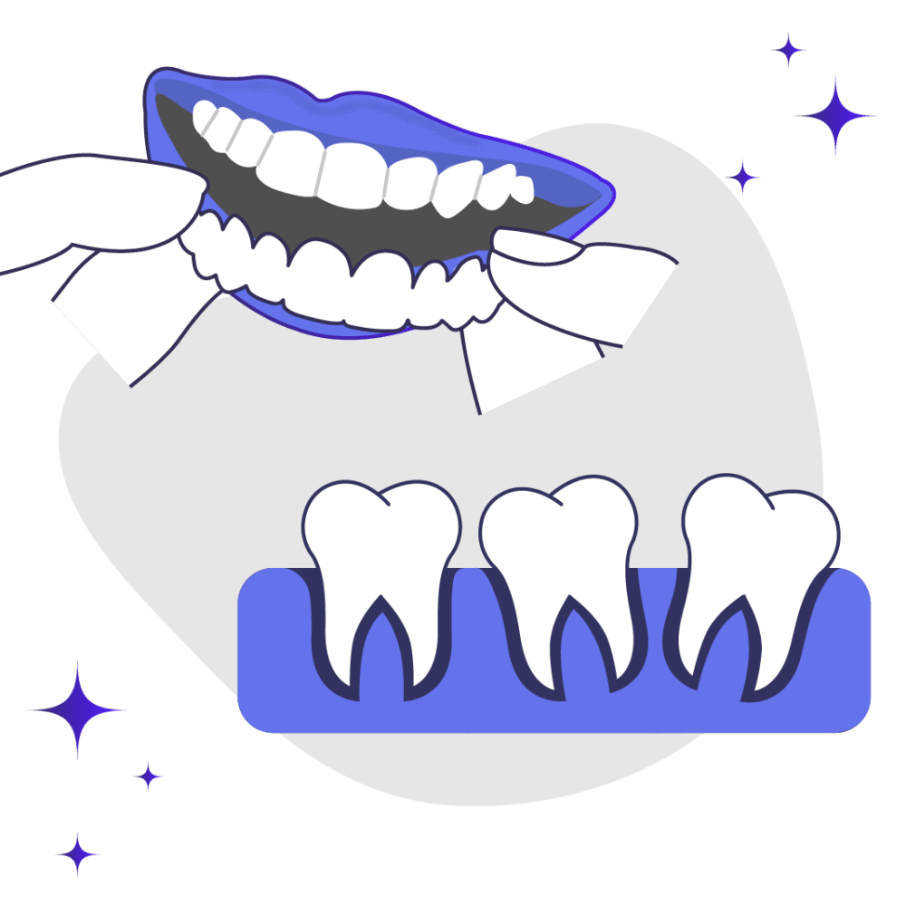 Snap on Veneers for Crooked Teeth