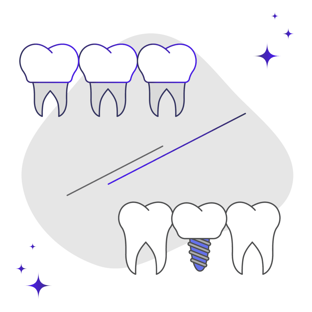 Veneers vs dental implants