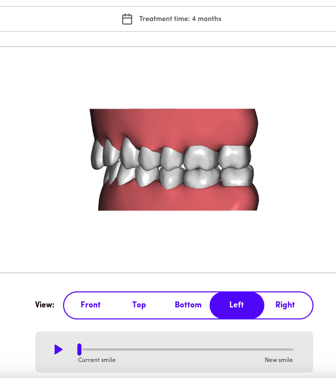 SmileMaker treatment preview side view