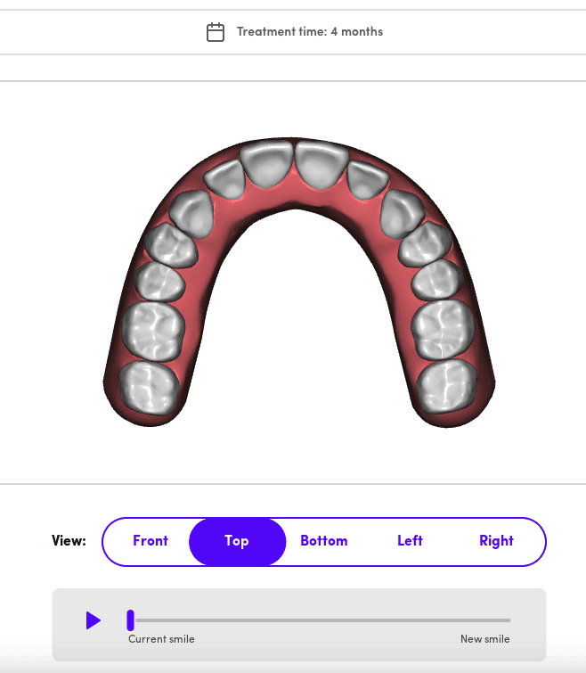 SmileMaker treatment preview bottom arch 