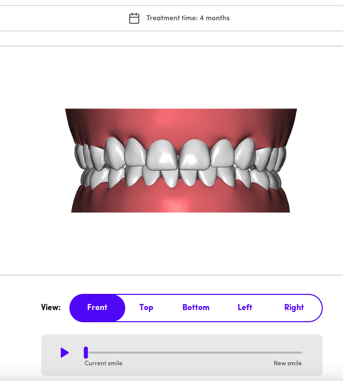 SmileMaker treatment preview front view